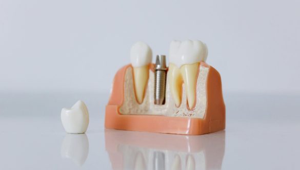 Dentures vs. Dental Implants: Exploring Your Options for a Complete Smile at ED Dental